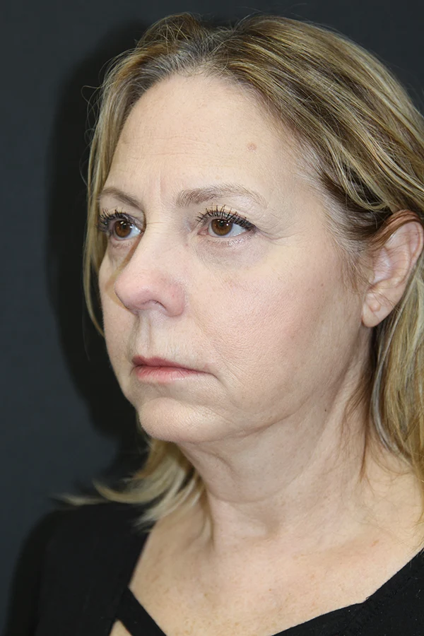 Eyelid Lift After Photo