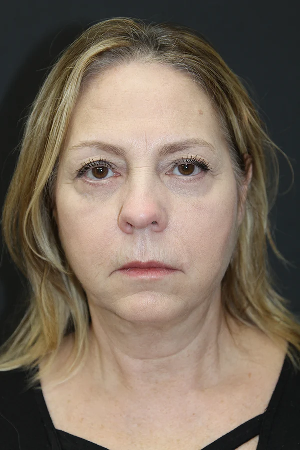 Eyelid Lift After Photo